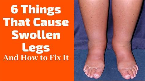 6 Things That Cause Swollen Legs And How To Fix It Youtube Swollen Legs