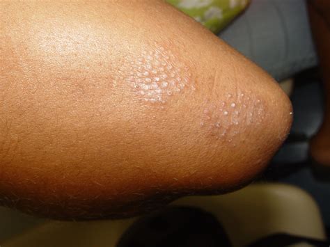 O Que E Qual A Causa Da Dermatite At Pica Prontopele