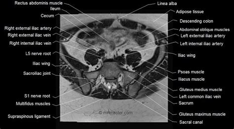 Mri Female Pelvis Anatomy Axial Image 2 Pelvis Anatomy Rectus