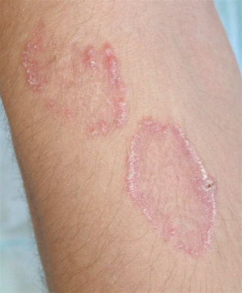 Dermdx Circles Of Scaly Papules Clinical Advisor