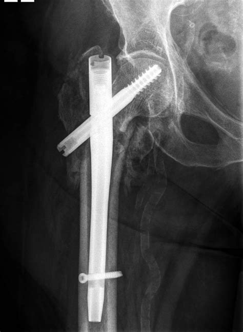 Medial Pelvic Migration Of The Lag Screw In A Short Gamma Nail After