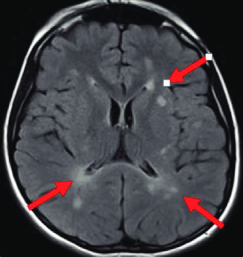 Periventricular And Subcortical White Matter Hyperintensities In T2w