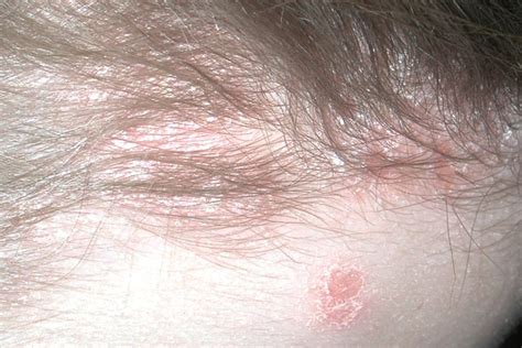 Pediatric Psoriasis