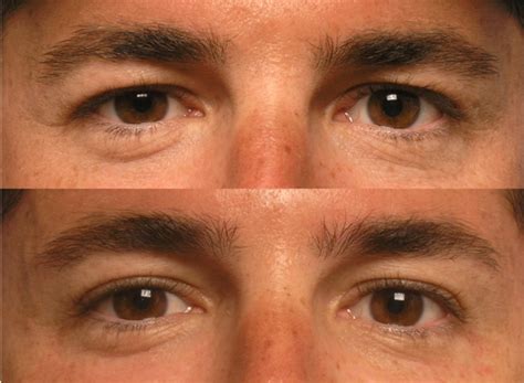 The 3 Types Of Droopy Eyelids