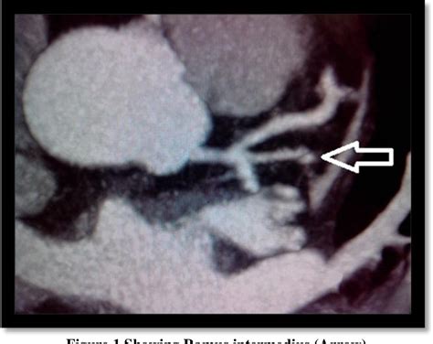 Figure 1 From Evaluation Of Anatomic Variations In Coronary Artery On