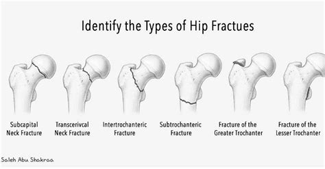 Hip Fracture Types