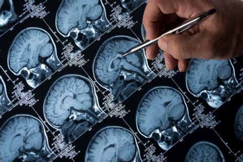 Brain Scan Evidence Plays An Increasing Role In Criminal Trials