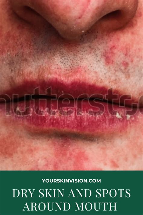 Dry Skin And Spots Around Mouth Causes And Treatments