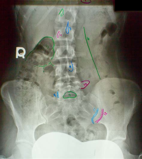 Ap Lumbar Spine Diagram Quizlet