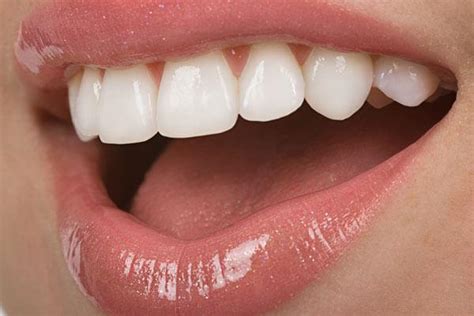 veneers    pictures popularity time color pros