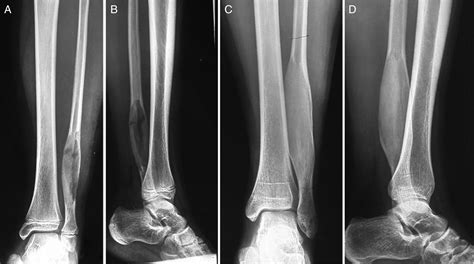 Reverse Transfer Of The Proximal Vascularized Fibula To Reconstruct The