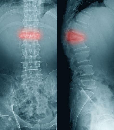 Backbone models by default provide the ways to persist themselves. Vertebral Compression Fracture | Osteoporosis Care Portland | IVC Northwest