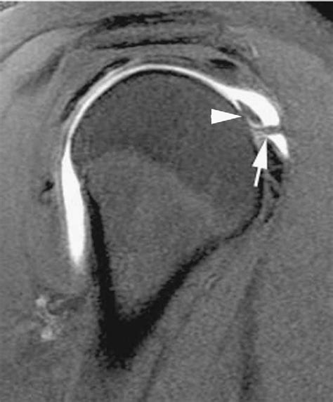 Figure From Mri Of Impingement Syndromes Of The Shoulder Semantic
