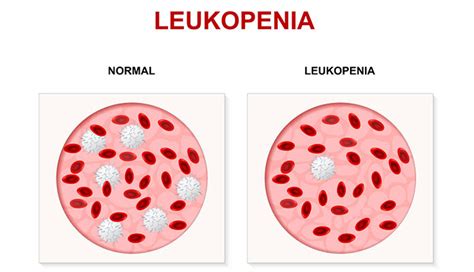 Leukopenia Symptoms Causes And Treatments New Life Ticket Part 14