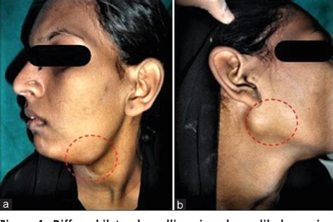 Figure 1 From Bilateral Submandibular Swelling Diagnosed As Tuberculous