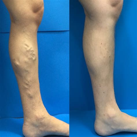 Before And After Vein Treatment Photos Vein Specialists Of The Carolinas