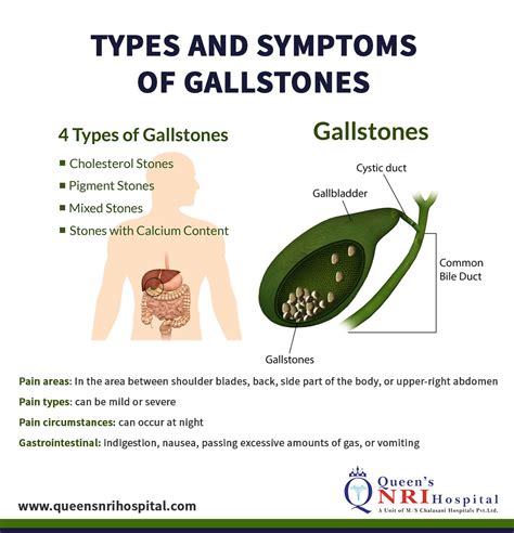 Location Of Gallstones Gallstones Symptoms And Causes