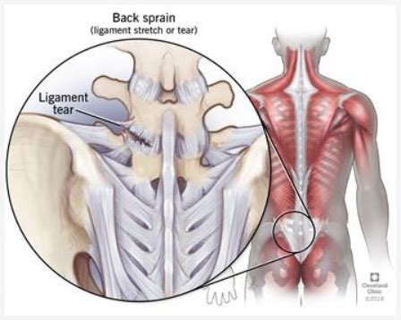 Diagram of backbone / thigh bone is not connected to the backbone | foodperson.com : Diagram Of Common Back Bone Break : Broken Hip: Types ...