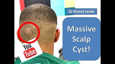 Massive Cyst Eruption Lipomacyst Com Dr Khaled Sadek Pimple Popping