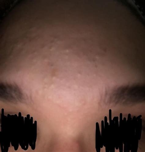 Acne How To Get Rid Of These Tiny White Bumps On The Top Of My Face