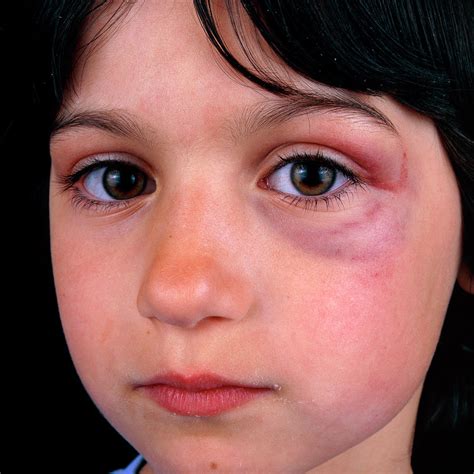 Girl With Black Eye Photograph By Alex Bartelscience Photo Library