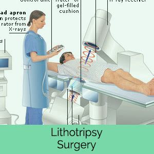 Kidney stone disease, also known as nephrolithiasis or urolithiasis, is when a solid piece of material (kidney stone) develops in the urinary tract. Kidney Stones Treatment Cost | Lithotripsy Surgery ...