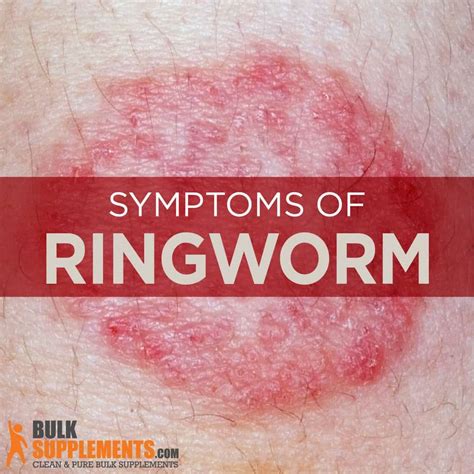Ringworm Symptoms Causes And Treatment