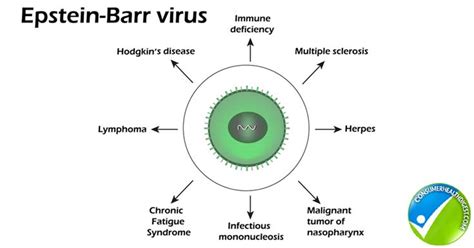 From latent genes to tumours. Epstein Barr Virus: The Sneaky Human Tumor Virus