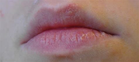 What Eos Lipbalm Did To My Lips Rashblister And Super Dry Lips Fluores