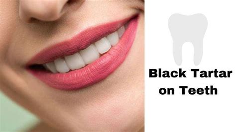 Black Tartar On Teeth Causes Symptoms Treatments