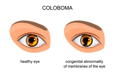 Coloboma Types Symptoms And Associated Conditions