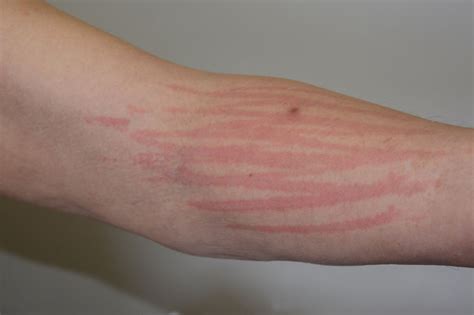 New Biologic For Urticaria