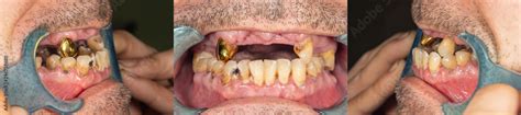 Rotten Teeth Caries And Plaque Close Up In An Asocially Ill Patient