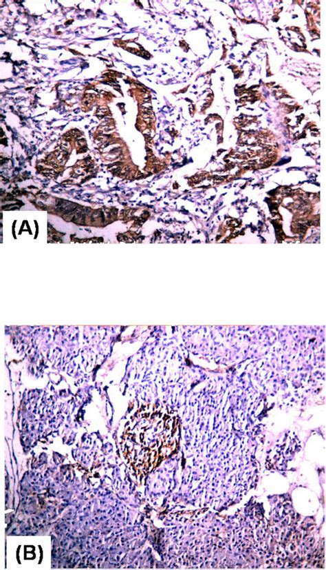 Immunohistochemical Staining Of P16 In Representative Cases Of A