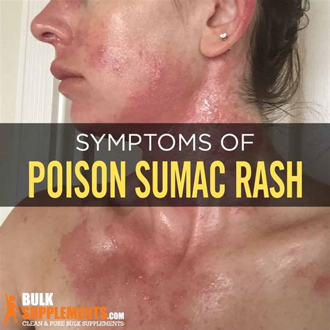 Poison Sumac Dont Let It Win Take Control And Soothe Rash Symptoms