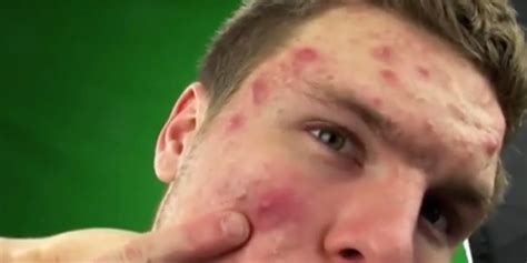 This Mans Acne Basically Disappeared When He Stopped Eating Dairy Self