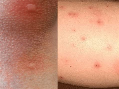 Whats The Difference Between Bed Bug Bites Vs Mosquito Bites