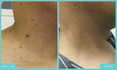 Skin Tags Removal Tampa Mole Removal Skintellect