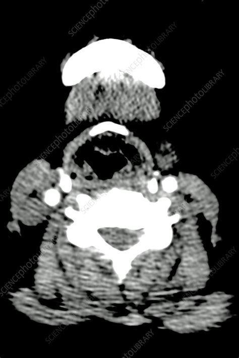 Heterogeneous Thyroid Ct Scan Stock Image C0394025 Science