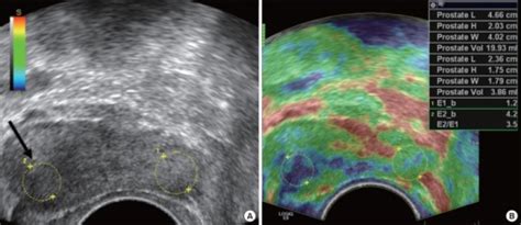 Typical Prostate Cancer Seen On Transrectal Ultrasound Open I