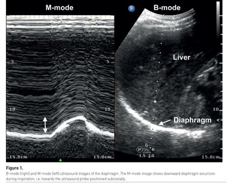 Using Ultrasound To Prevent Diaphragm Dysfunction