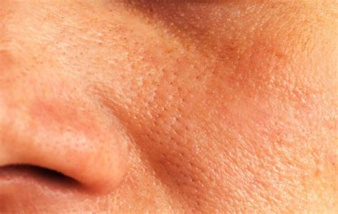 1 Clogged Pores Symptoms And Causes