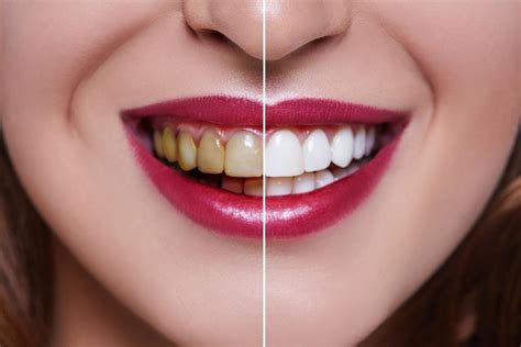 The Benefits Of A Deep Cleaning Treatment For Your Teeth And Gums When