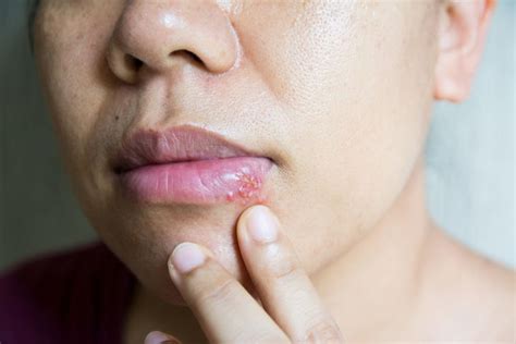 9 Signs Of Herpes You Cant Ignore Facty Health