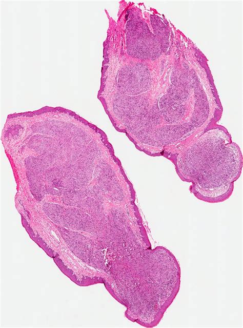 Palisaded Encapsulated Solitary Circumscribed Neuroma Of The Oral