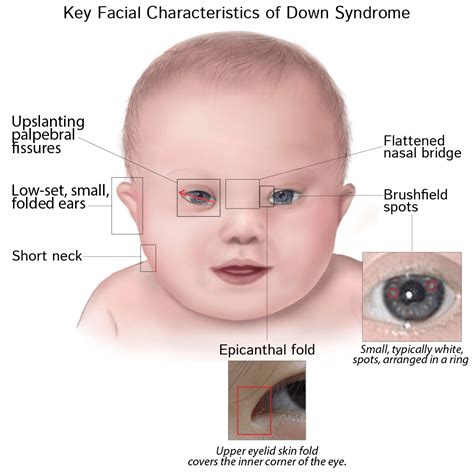 In the u.s., down syndrome is the least funded major genetic condition by our national institutes of health despite being the most frequent chromosomal disorder. Down's Syndrome: Let's Learn More About The Causes ...