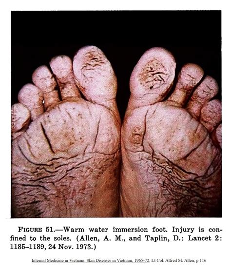 The Woodsmans Journal Online Wet Feet Immersion Foot Part One©