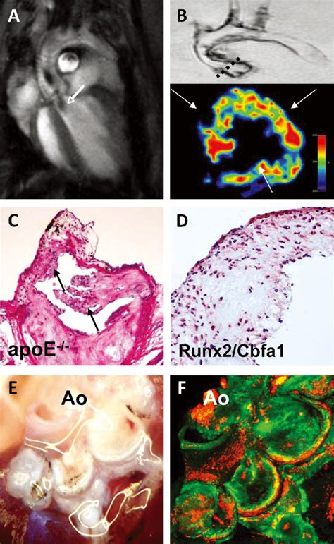 Visualizing Aortic Valve Calcification A Magnetic Resonance Imaging