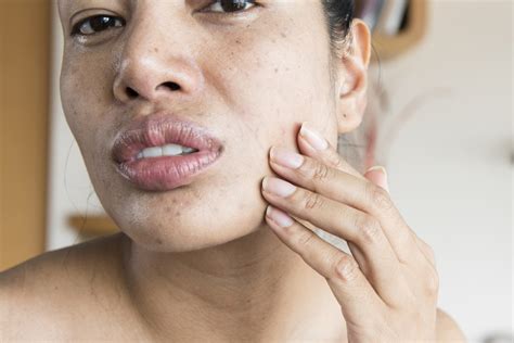 Dry Skin Around The Mouth And Chin Causes Treatments And Prevention