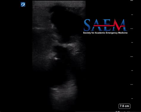 Saem Clinical Image Series What Lies Beneath